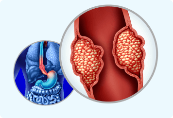 Adenocarcinoma example