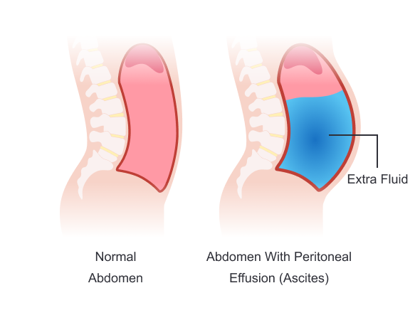 Normal abdomen versus abdomen with Peritoneal Effusion