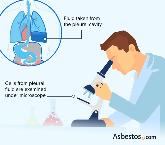 Cytology from pleural cavity