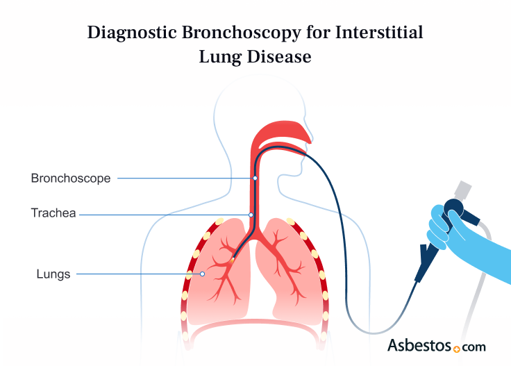 Diagnostic Bronchoscopy for Interstitial Lung Disease