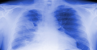 Asbestosis: Know the Causes, Symptoms, Treatment and More