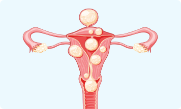 Example of uterine fibroids