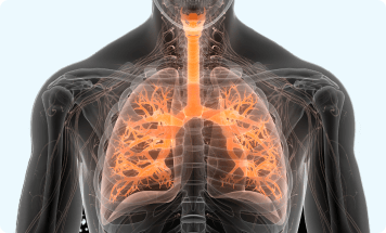 Example of fibrosis