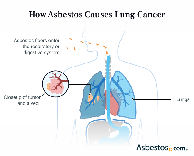 Illustration of How Asbestos Can Cause Lung Cancer