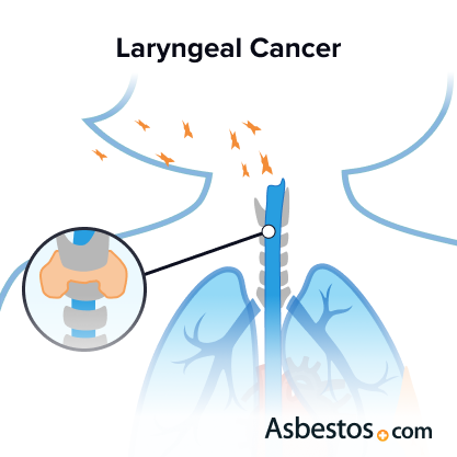 Laryngeal cancer