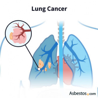 What Types of Cancers Are Caused by Asbestos?