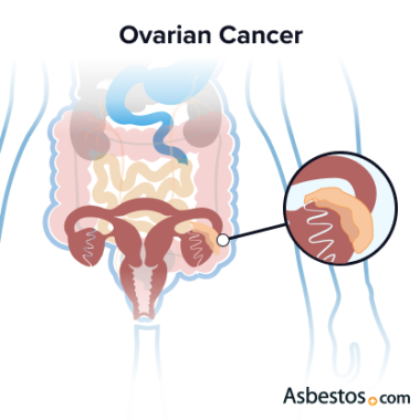 ovarian cancer