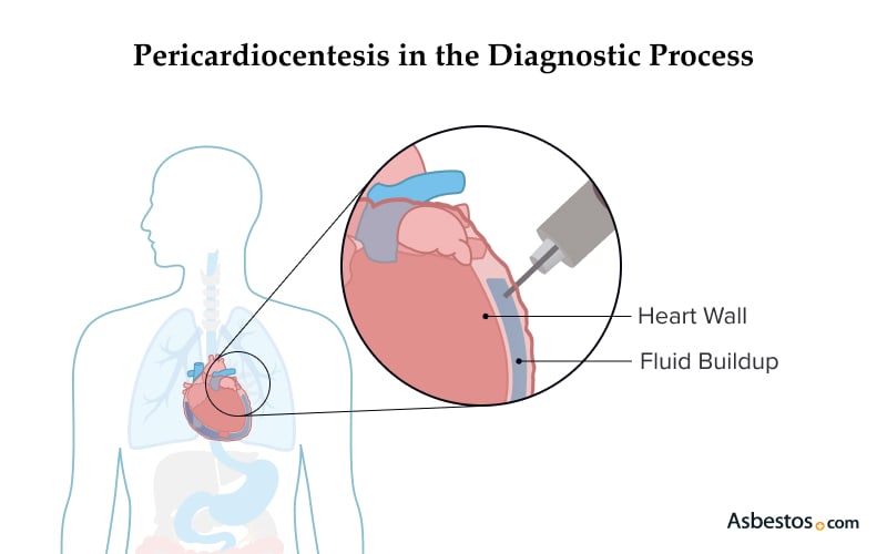 Pericardiocentesis in the Diagnostic Process
