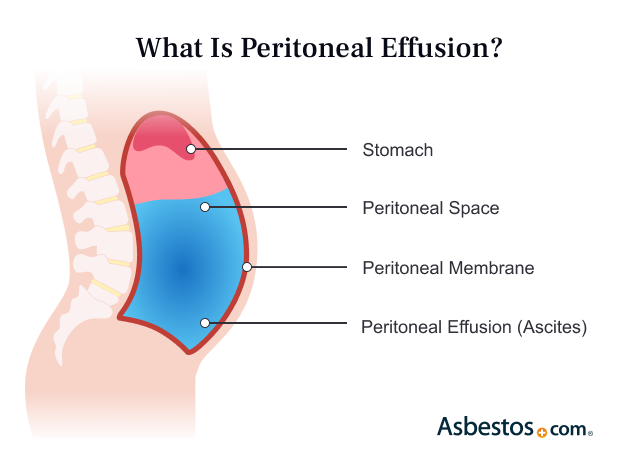 What is Peritoneal Effusion?