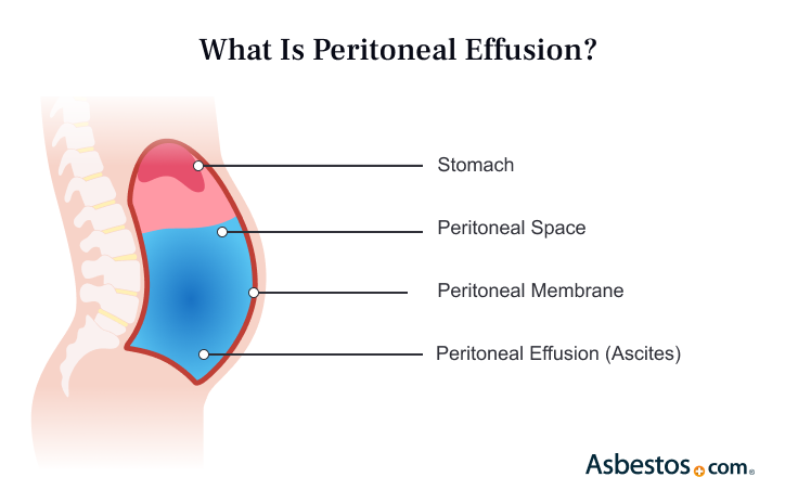 A diagram showing where peritoneal effusion occurs.