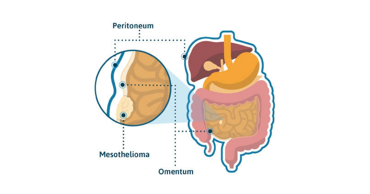 mesotheioma