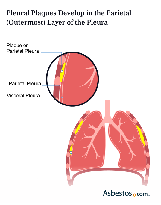 Illustration of Pleural Plaques in the Parietal Layer of the Pleura