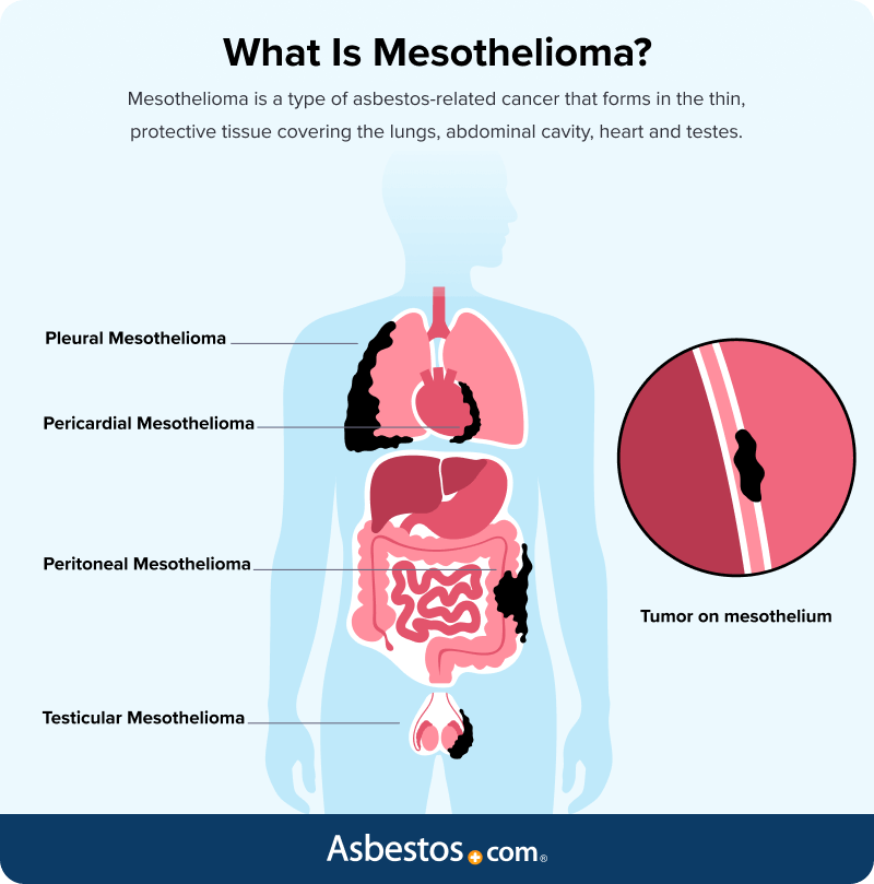 What mesothelioma is and where different types occur in the body