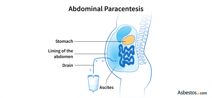 Paracentesis for Mesothelioma | Alleviate Cancer Symptoms
