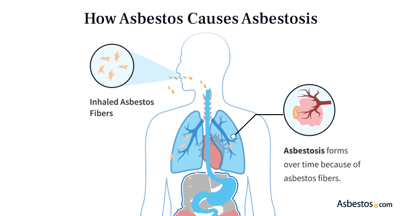 How asbestos causes asbestosis