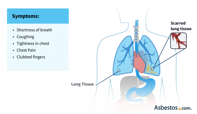 sarcoidosis life expectancy in the lung