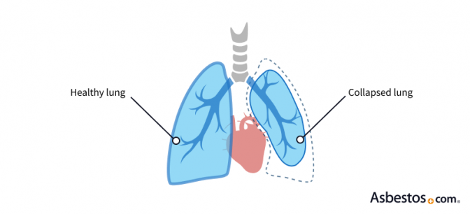 List of Asbestos-Related Diseases