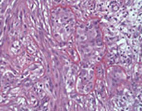 Biphasic mesothelioma cells