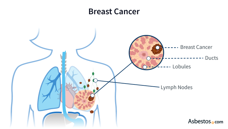 Breast Cancer - Elevated Risks from Asbestos Exposure