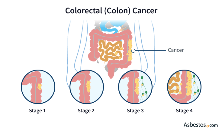 Colorectal (Colon) Cancer and Asbestos Exposure
