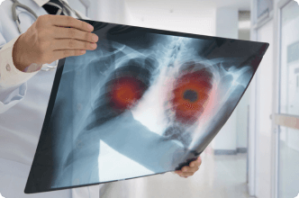 Doctor reviews x-ray of lungs
