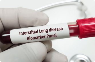 Interstitial lung disease biomarker