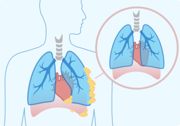 Localized treatment example, surgical removal of tumors