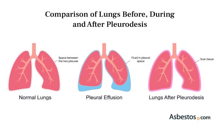 Comparison of lungs, before and after pleurodesis