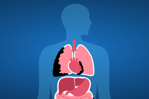 mesothelioma cover graphic