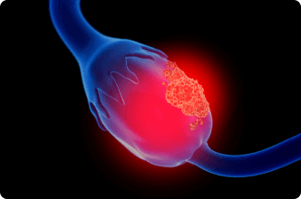 Closeup view of ovarian cancer