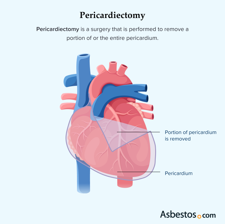 Pericardiectomy graphic