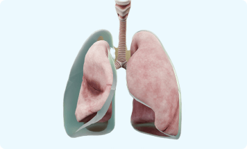 Example of pleural effusion