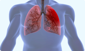 example of pleurisy