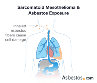 Diagram of how inhaling asbestos fibers can cause sarcomatoid mesothelioma.