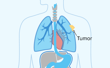 Stage 1 mesothelioma