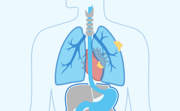 stage 2 mesothelioma