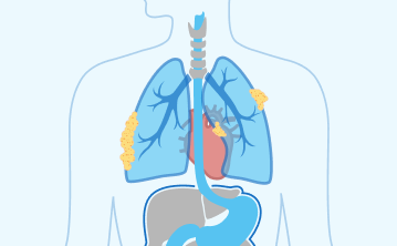 Stage 3 mesothelioma