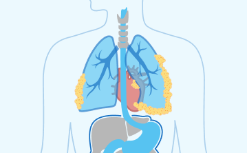 Stage 4 mesothelioma