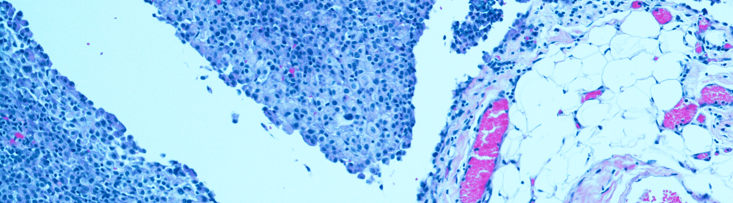 Mesothelioma cells