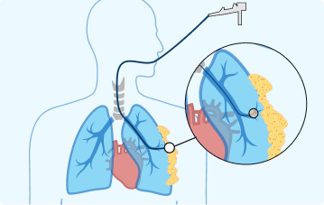 Brachytherapy graphic