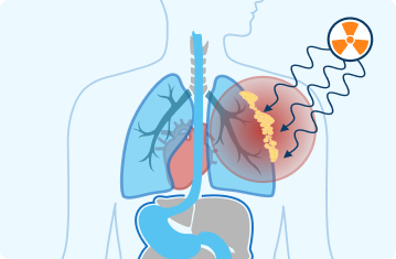 Targeted therapy example