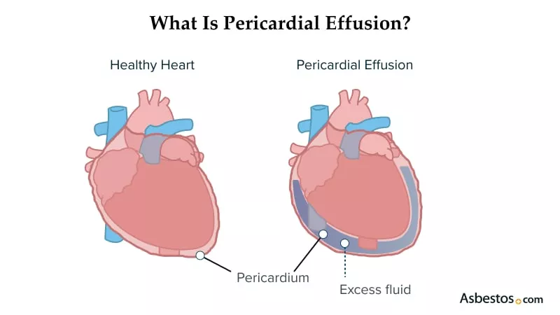 Diagramme montrant le mésothéliome péricardique affectant le cœur