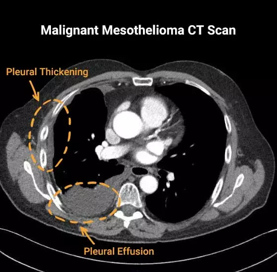 Malignant mesothelioma CT-scan