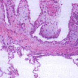 Papillary Mesothelioma – Diagnosis, Prognosis & Treatments